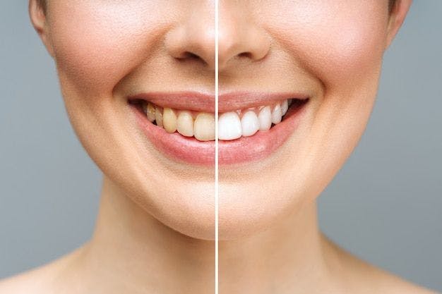 Dental Implant: Teeth Should Always Be in Style