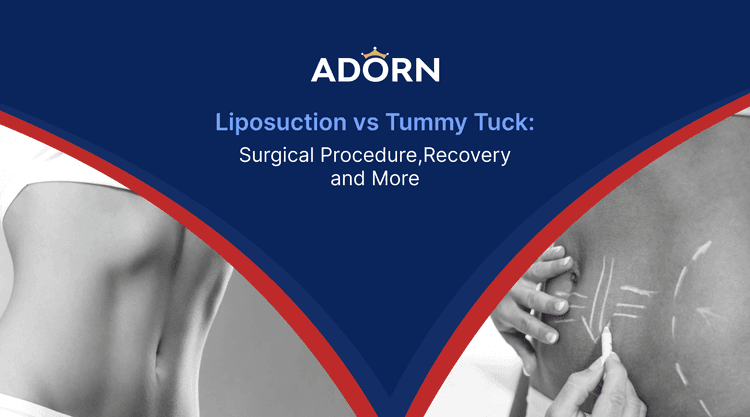 Liposuction Tummy Tuck Ahmedabad