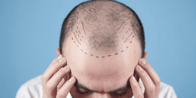 The Hair Transplant Revolution: Advanced Solutions for Extensive Baldness