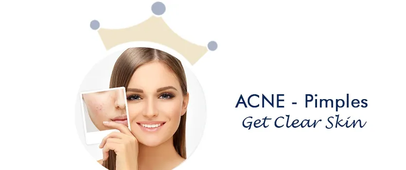 Acne treatment in Ahmedabad 