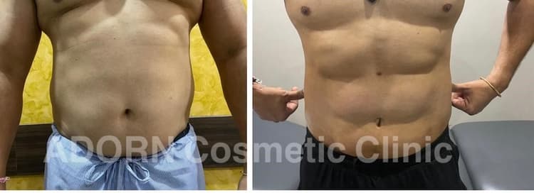 Six Pack Abs Ahmedabad Before After