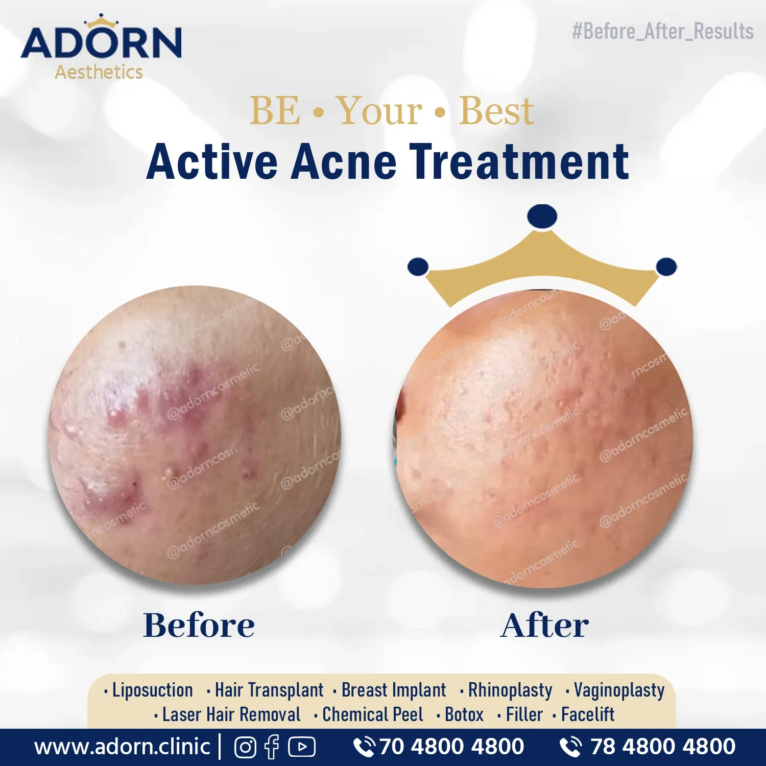 Acne | Before and After Plastic Surgery Results | Adorn Clinic