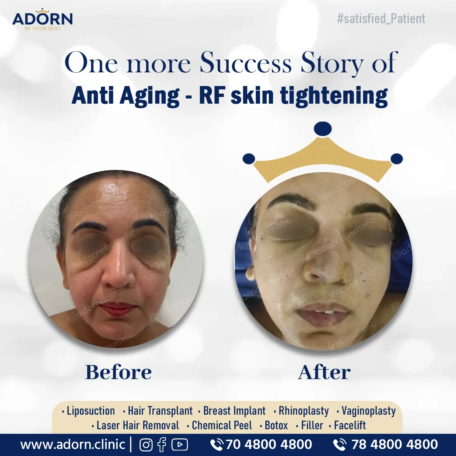 Anti aging RF Accutite / morpheus8 | Before and After Plastic Surgery Results | Adorn Clinic