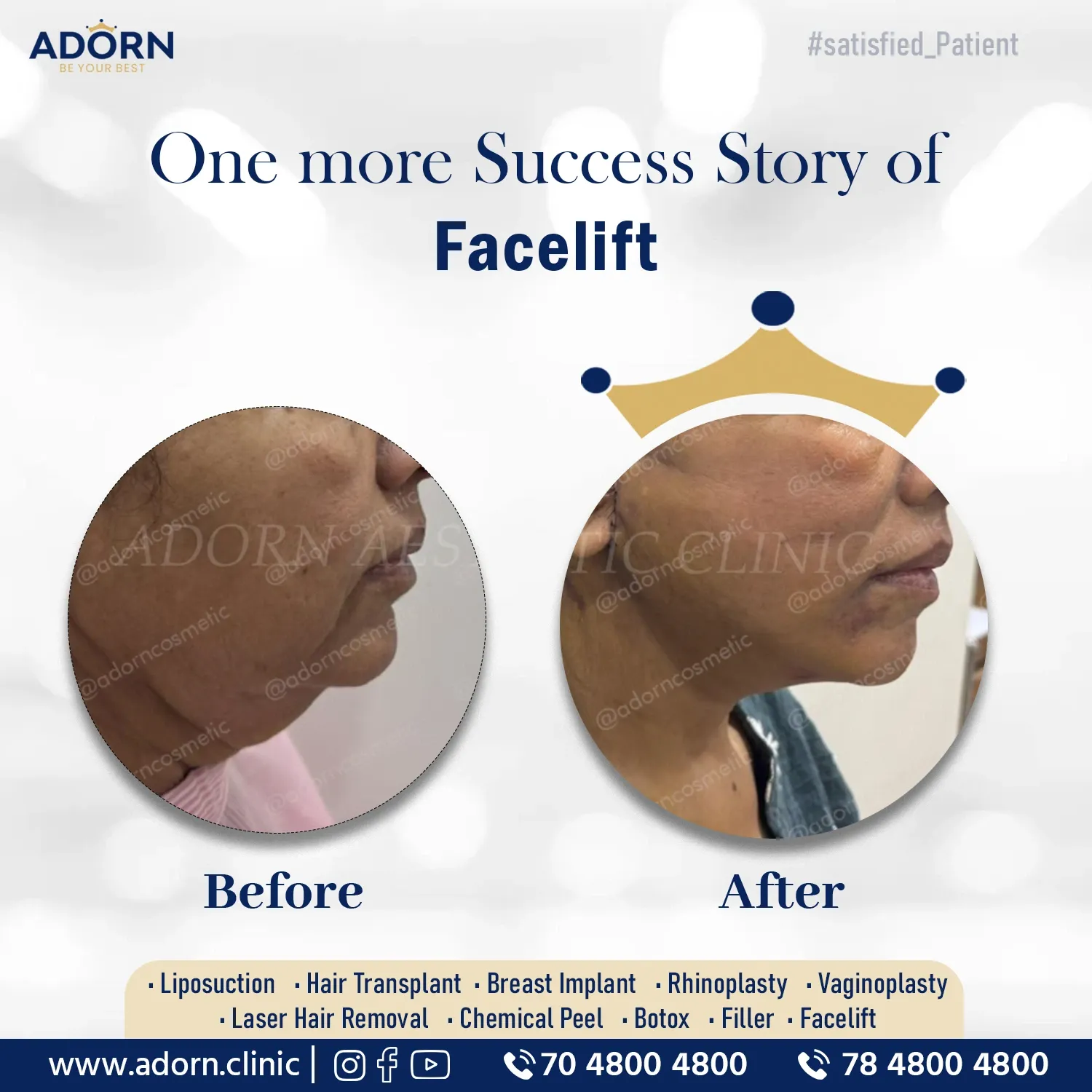 Lower Face + Neck Lift | Before and After Plastic Surgery Results | Adorn Clinic
