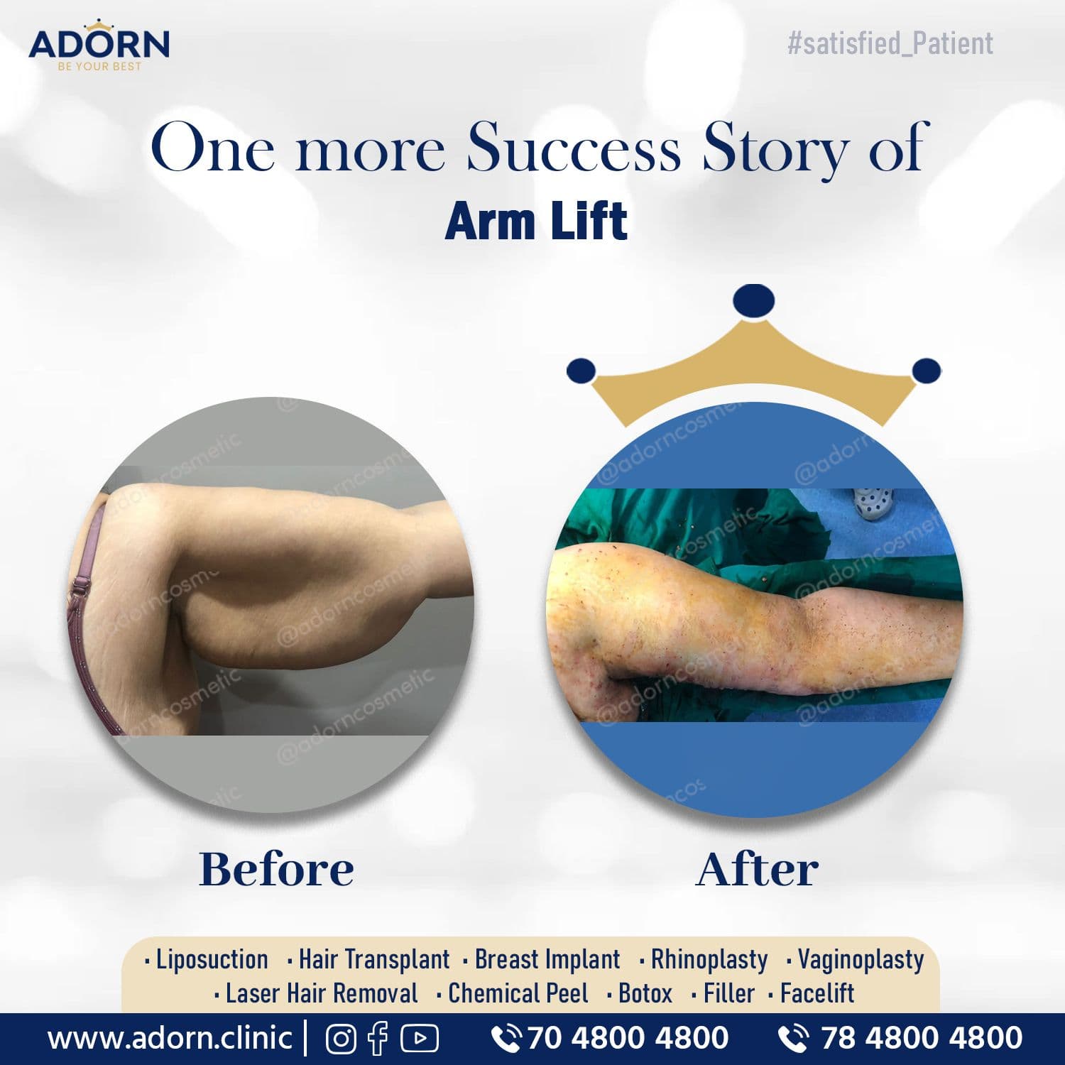 Arm Lift | Before and After Plastic Surgery Results | Adorn Clinic