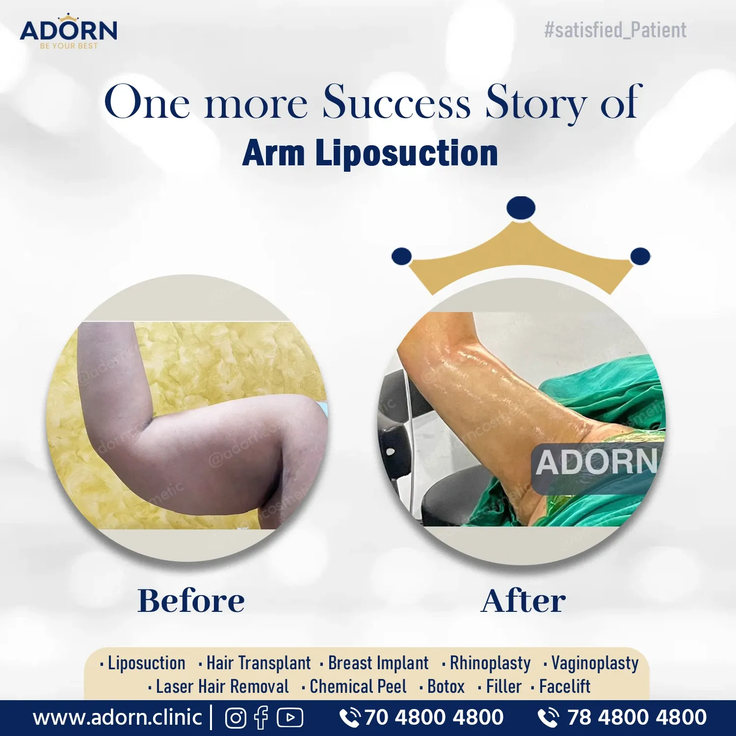Arm Liposuction | Before and After Plastic Surgery Results | Adorn Clinic