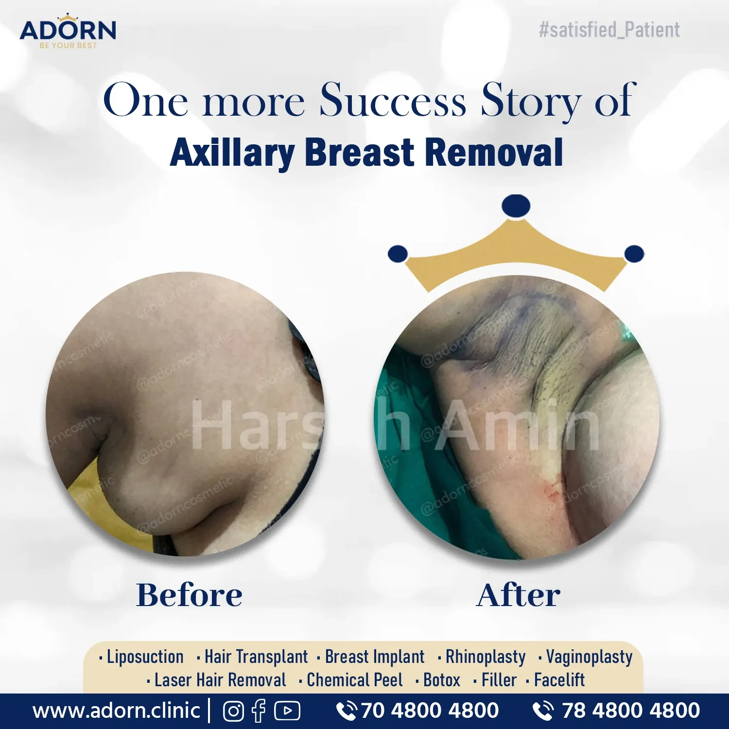 Axillary Breast Liposuction | Before and After Plastic Surgery Results | Adorn Clinic