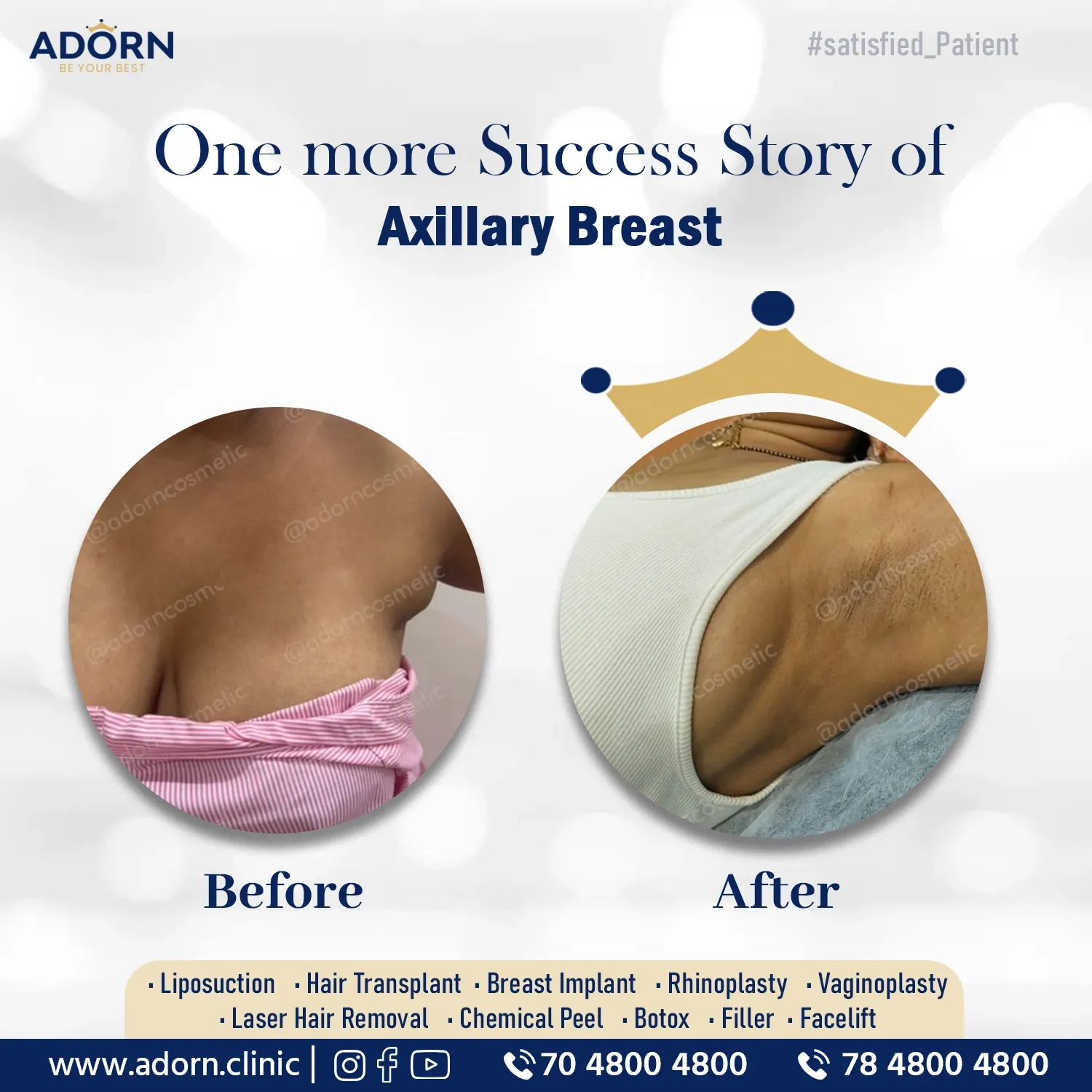 Axillary Breast Liposuction | Before and After Plastic Surgery Results | Adorn Clinic