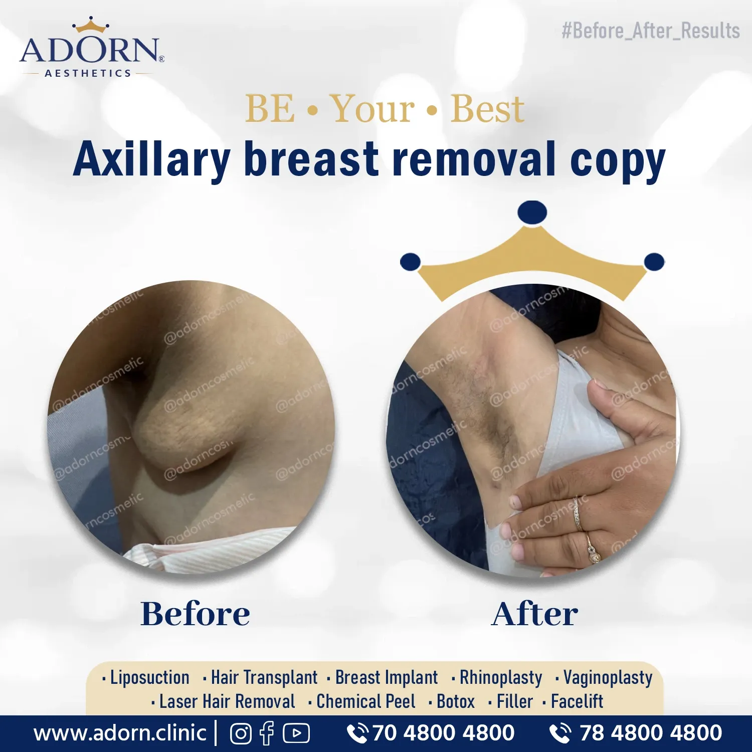 Axillary Breast | Before and After Plastic Surgery Results | Adorn Clinic