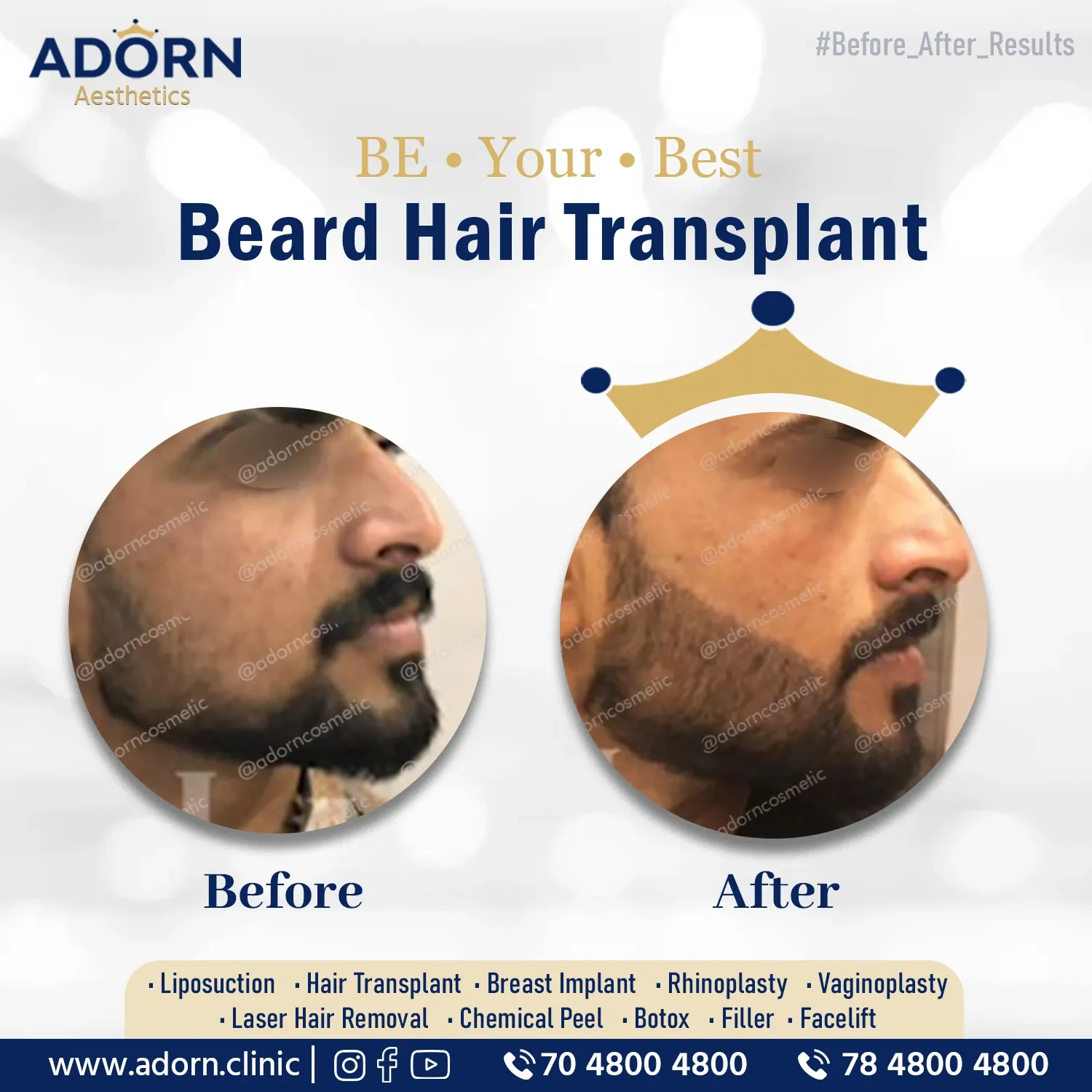 Patchy Beard | Before and After Plastic Surgery Results | Adorn Clinic