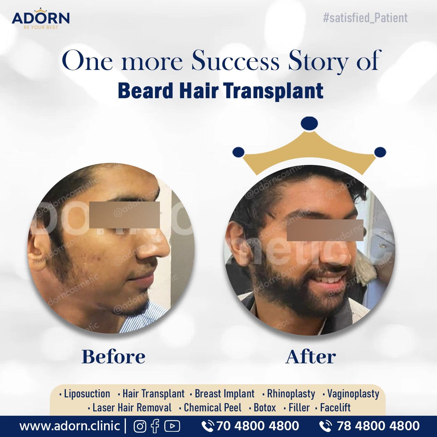 Beard Hair Transplant | Before and After Plastic Surgery Results | Adorn Clinic