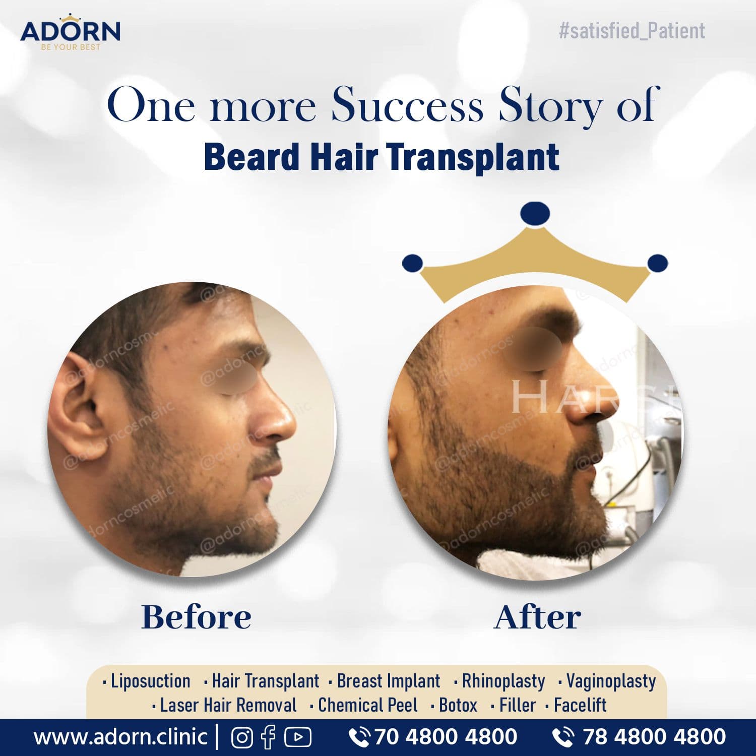 Beard Growth | Before and After Plastic Surgery Results | Adorn Clinic