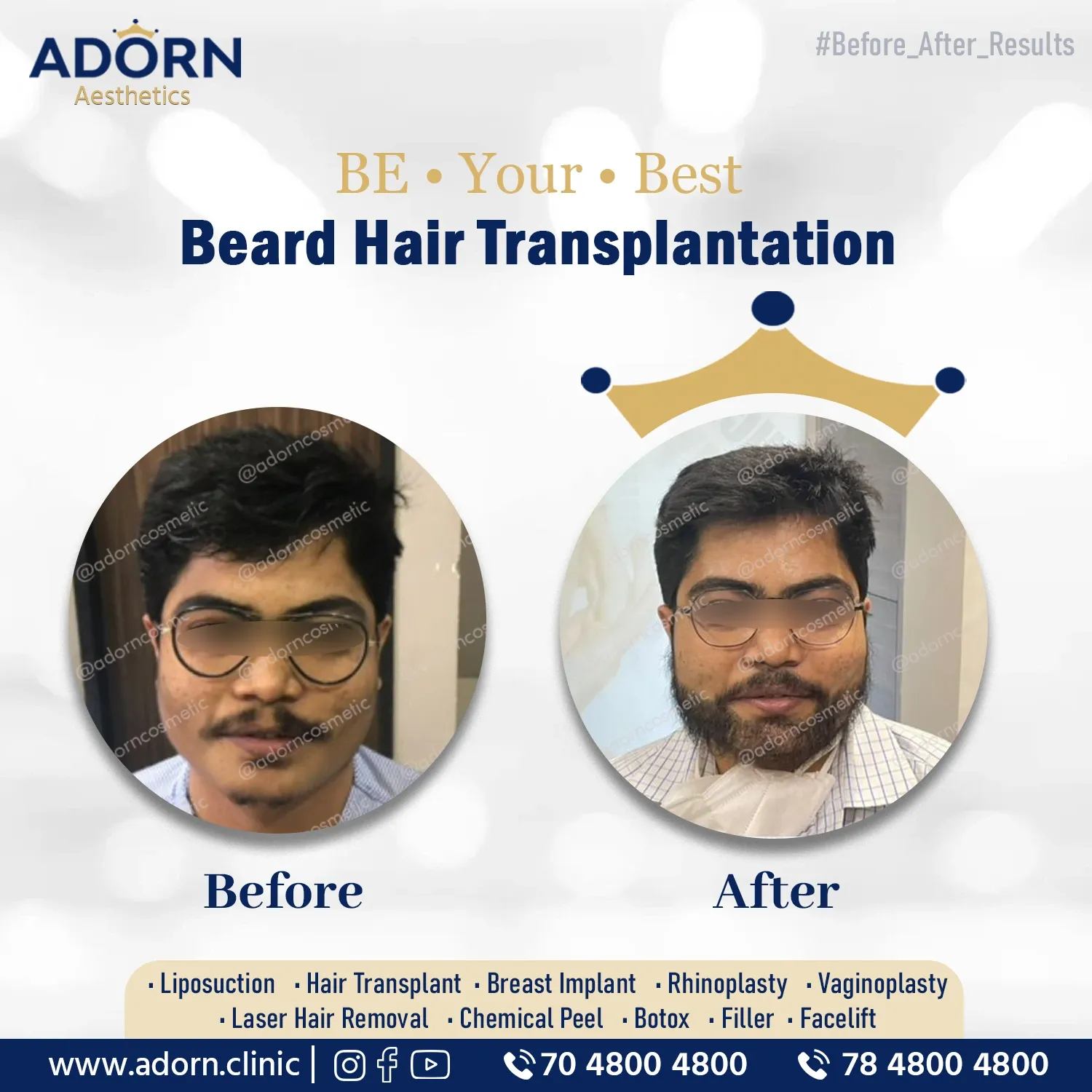 Full Beard | Before and After Plastic Surgery Results | Adorn Clinic