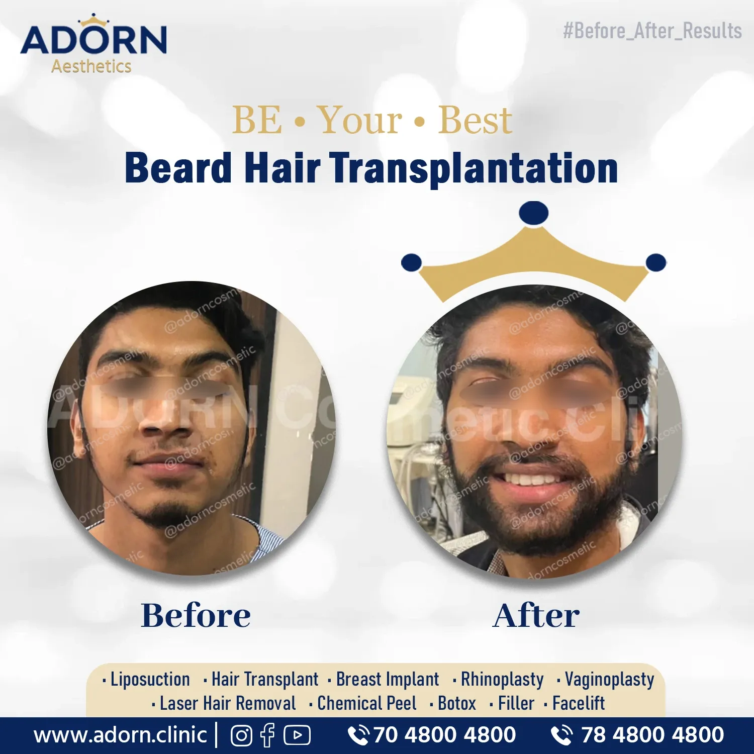 Beard Hair Transplant post Injury | Before and After Plastic Surgery Results | Adorn Clinic