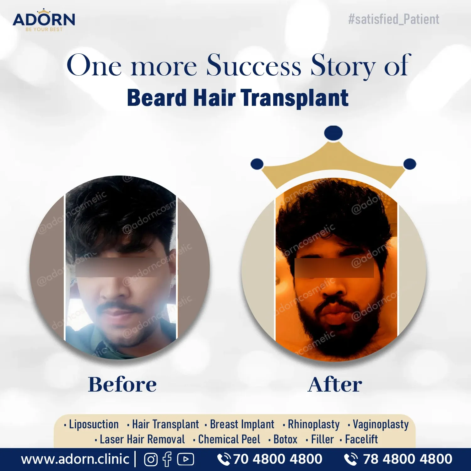 Full beard Hair Transplant | Before and After Plastic Surgery Results | Adorn Clinic