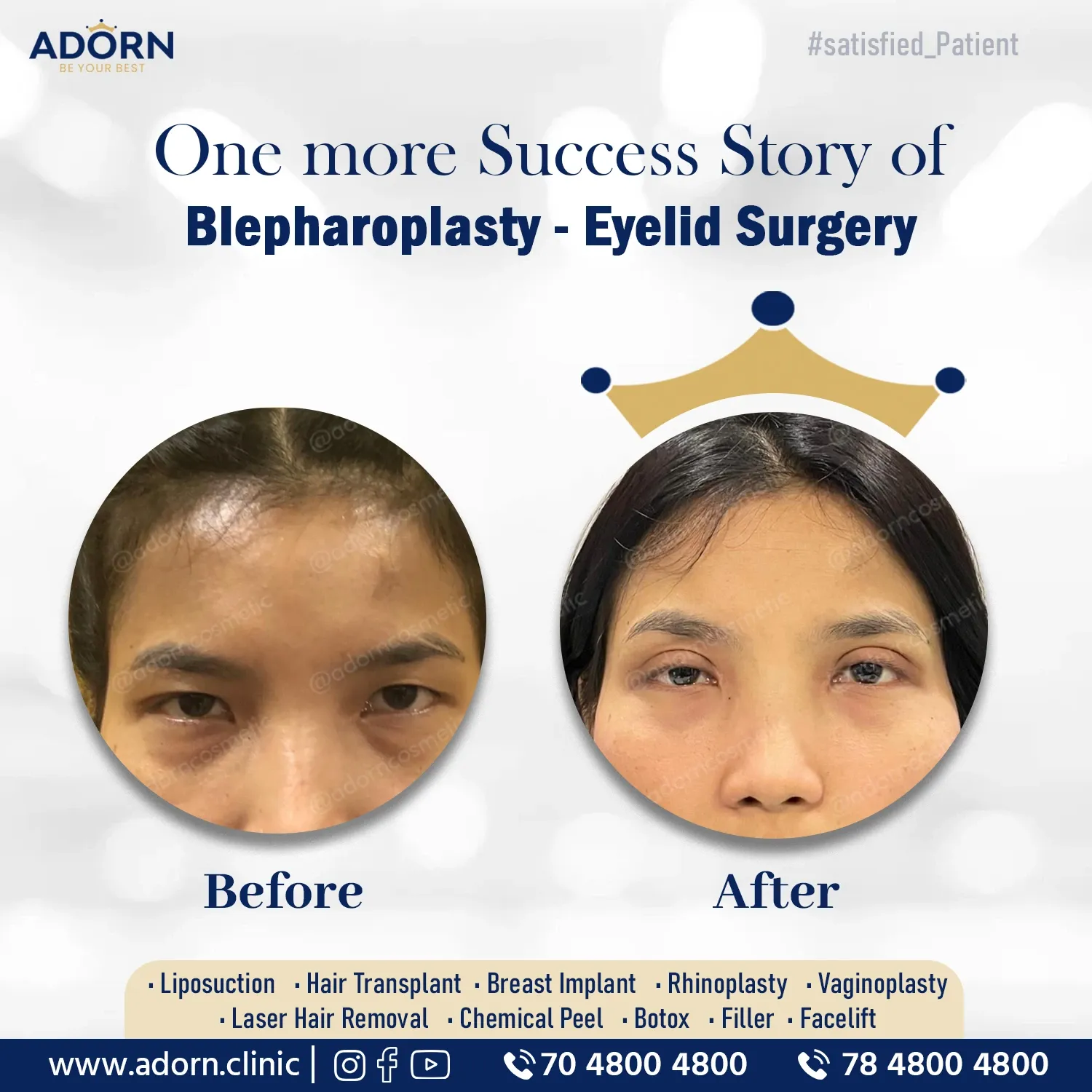 Double Eyelid + Epicanthal Fold | Before and After Plastic Surgery Results | Adorn Clinic