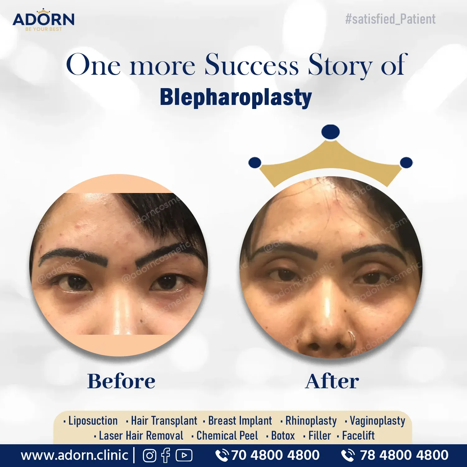 Double Eyelid Blepharoplasty | Before and After Plastic Surgery Results | Adorn Clinic
