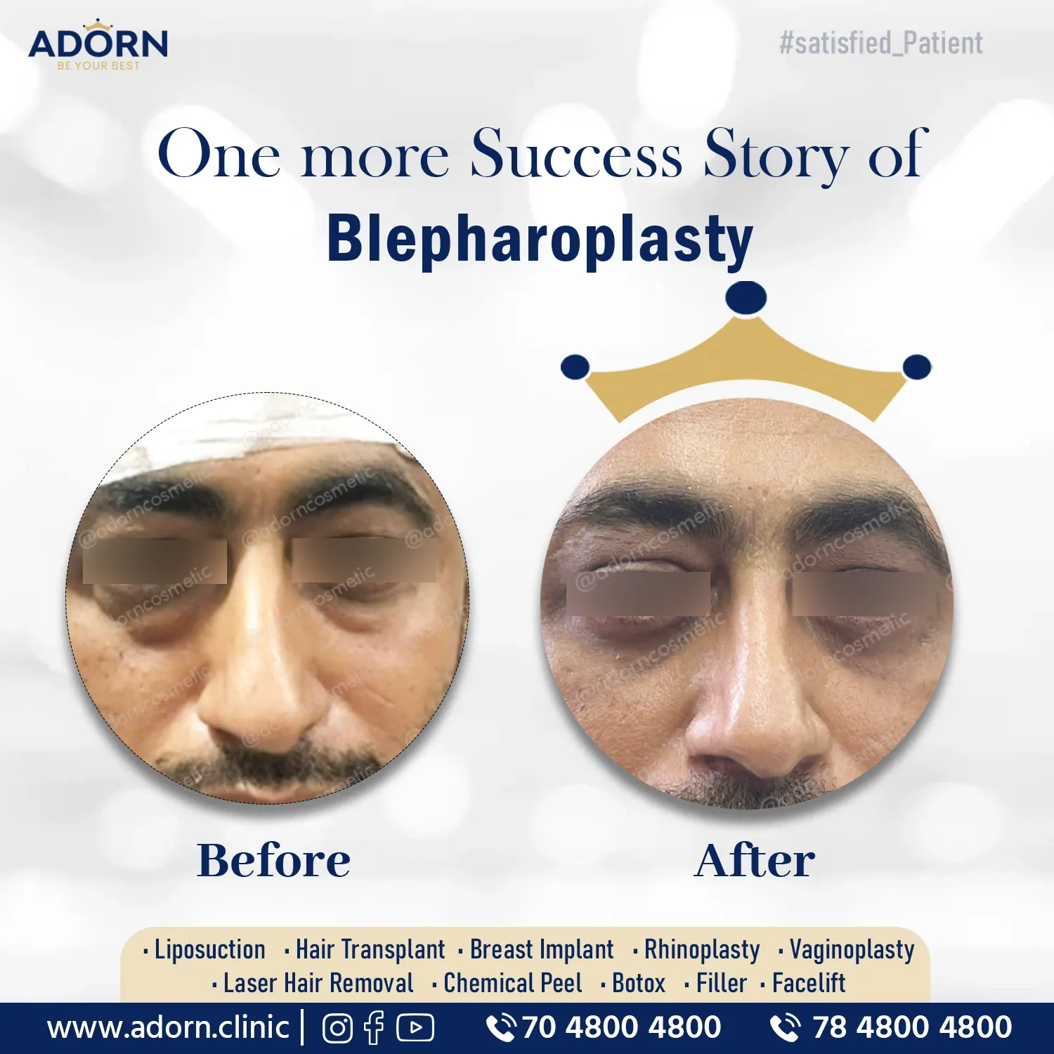 Lower Lid Puffyness | Before and After Plastic Surgery Results | Adorn Clinic