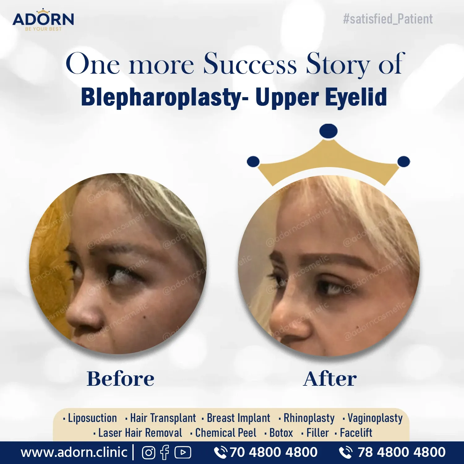 Oriental Blepharoplasty | Before and After Plastic Surgery Results | Adorn Clinic