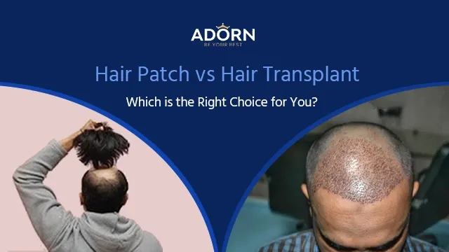 Hair Patch / Hair wig in Ahmedabad Best Hair patch wig vs natural hair transplant