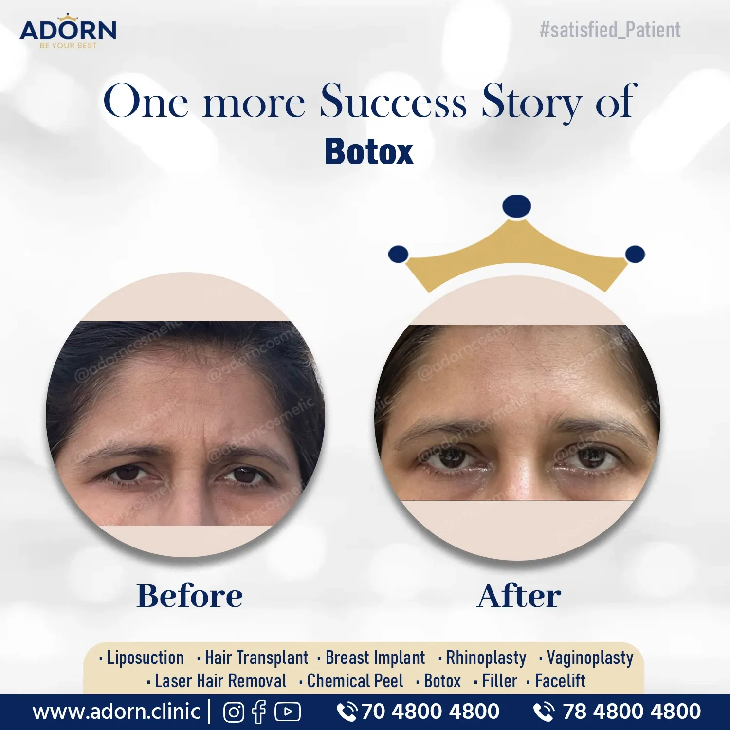 Botox glabellar lines | Before and After Plastic Surgery Results | Adorn Clinic