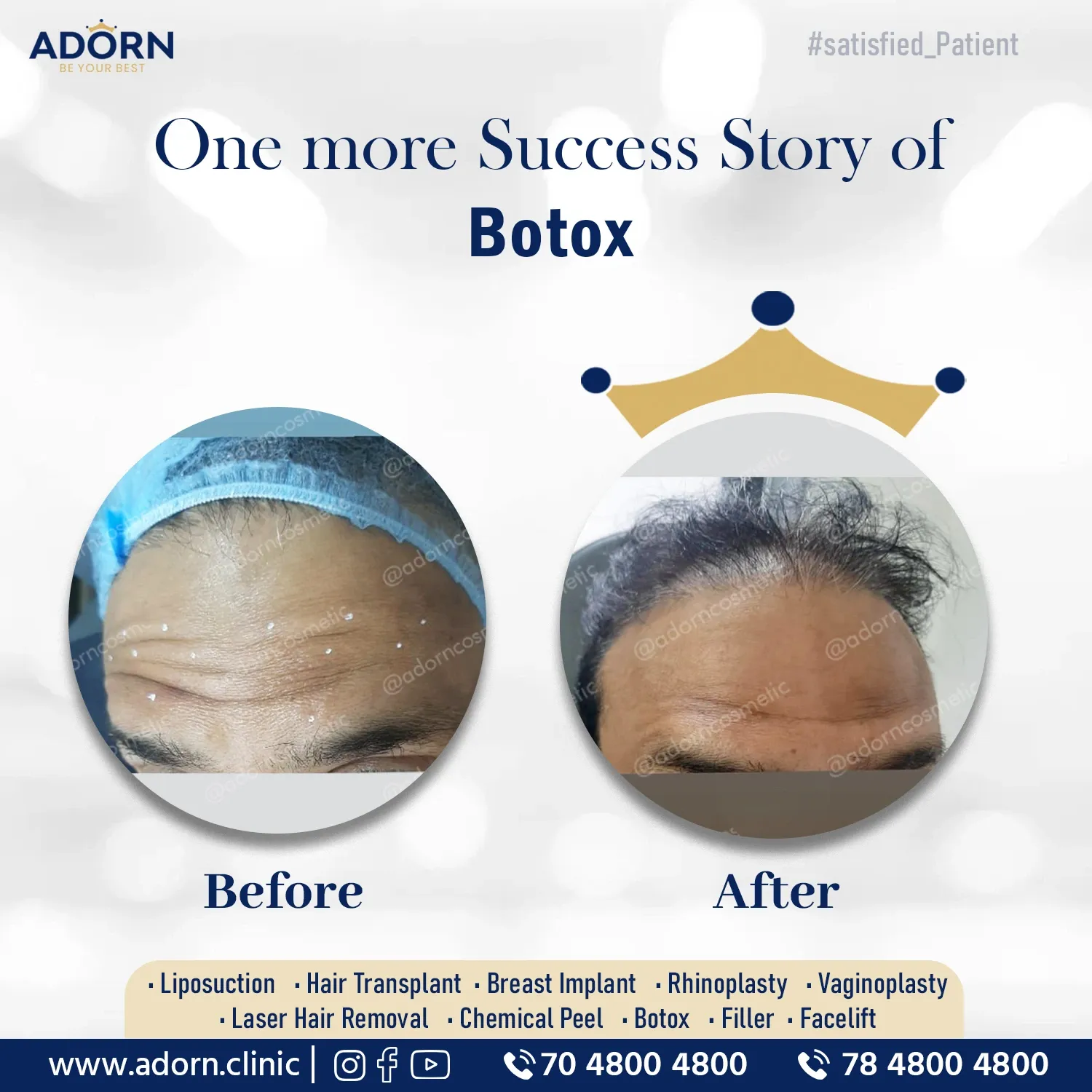Forehead wrinkles | Before and After Plastic Surgery Results | Adorn Clinic