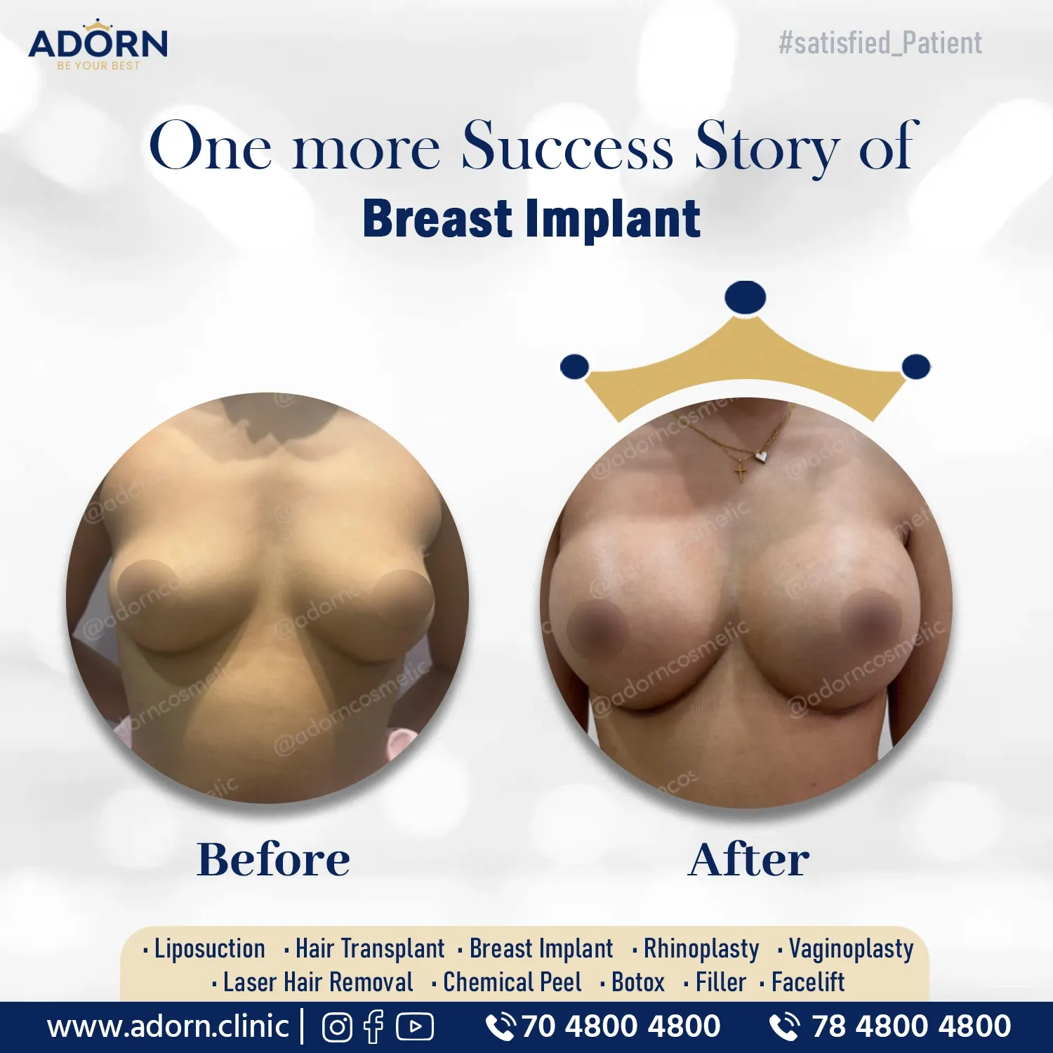 Breast implant 320 cc round | Before and After Plastic Surgery Results | Adorn Clinic