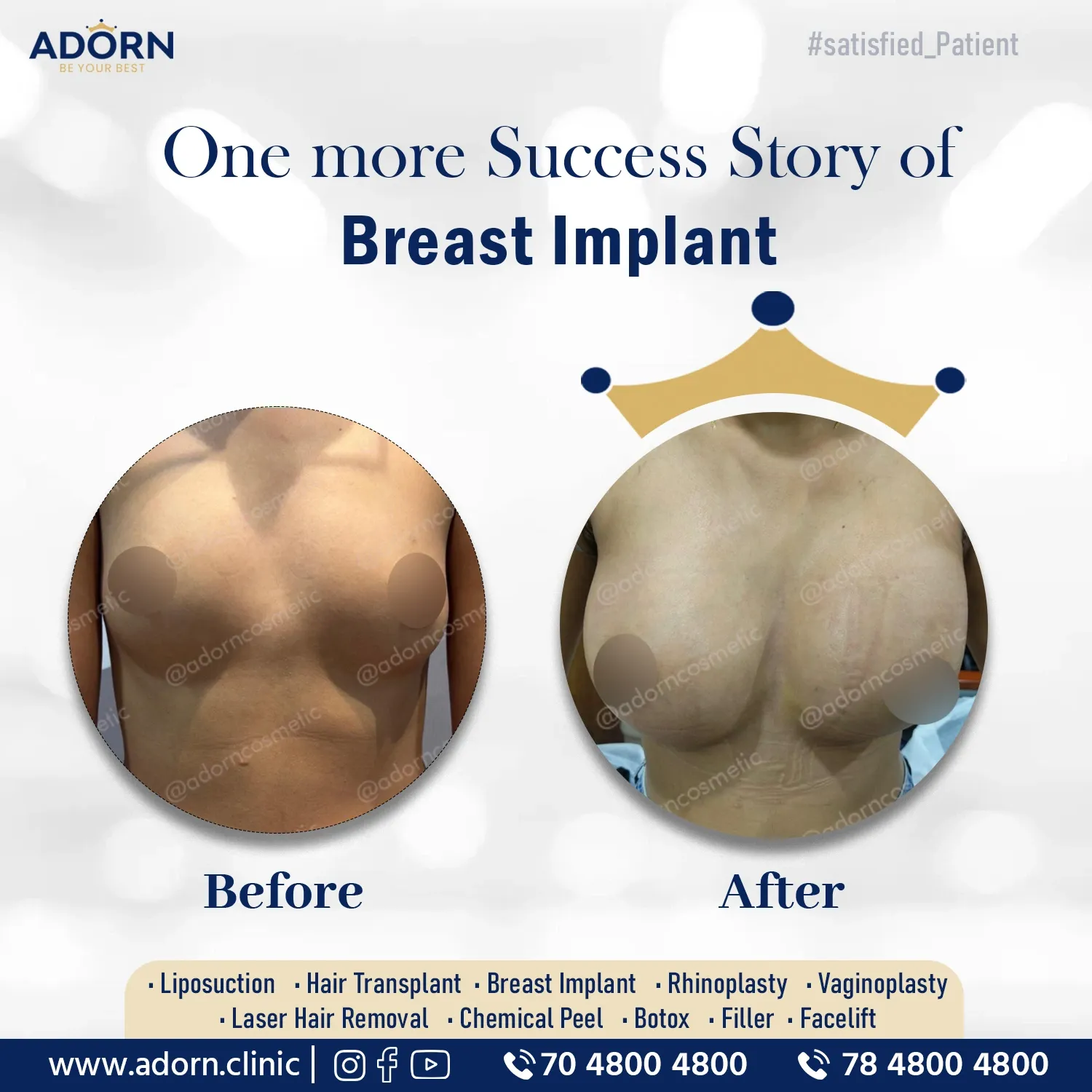 Breast Implant | Before and After Plastic Surgery Results | Adorn Clinic