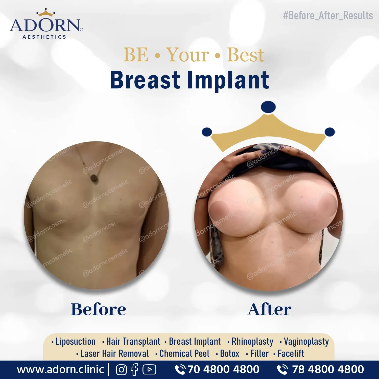 Breast Augmentation Result | Before and After Plastic Surgery Results | Adorn Clinic