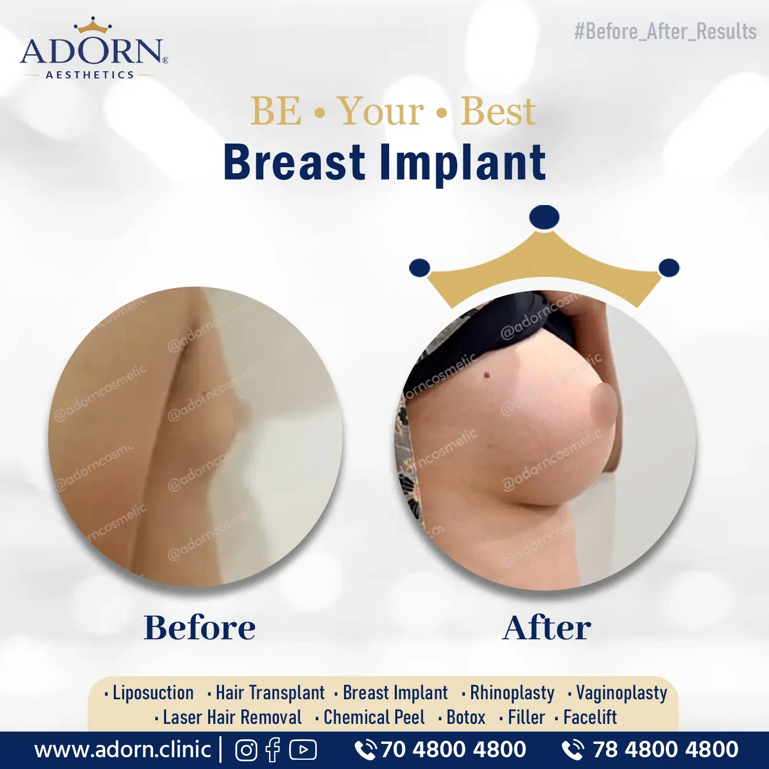 Breast Implant Lateral | Before and After Plastic Surgery Results | Adorn Clinic