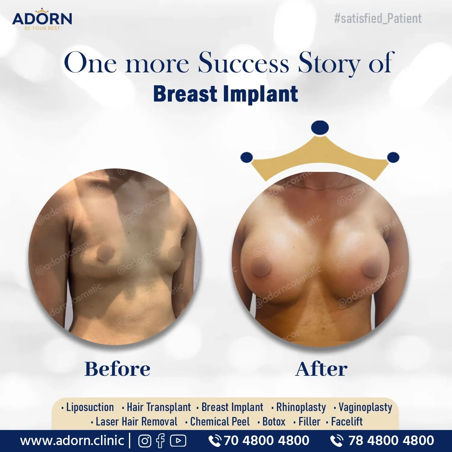 Silicon Breast Implant | Before and After Plastic Surgery Results | Adorn Clinic
