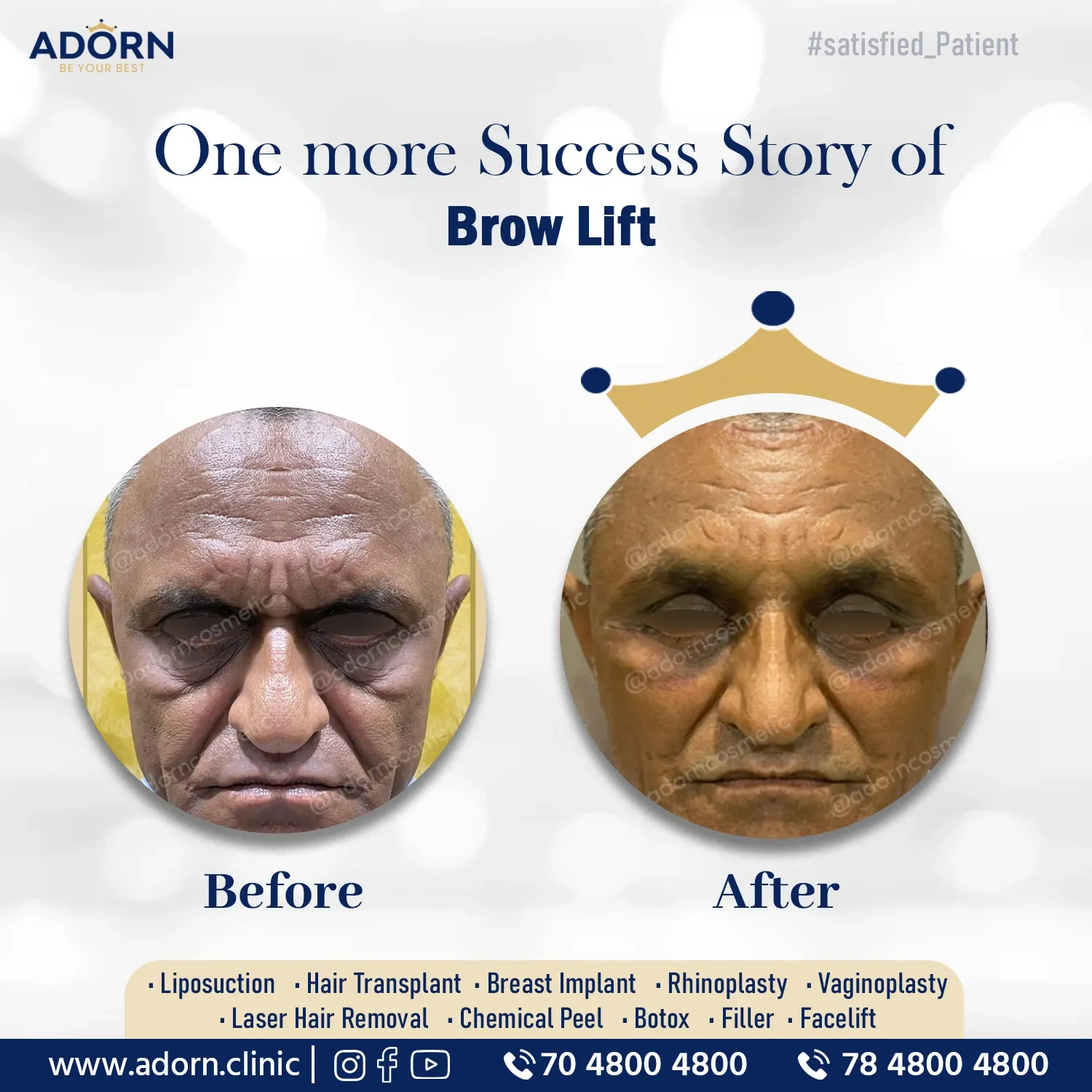 Browlift | Before and After Plastic Surgery Results | Adorn Clinic
