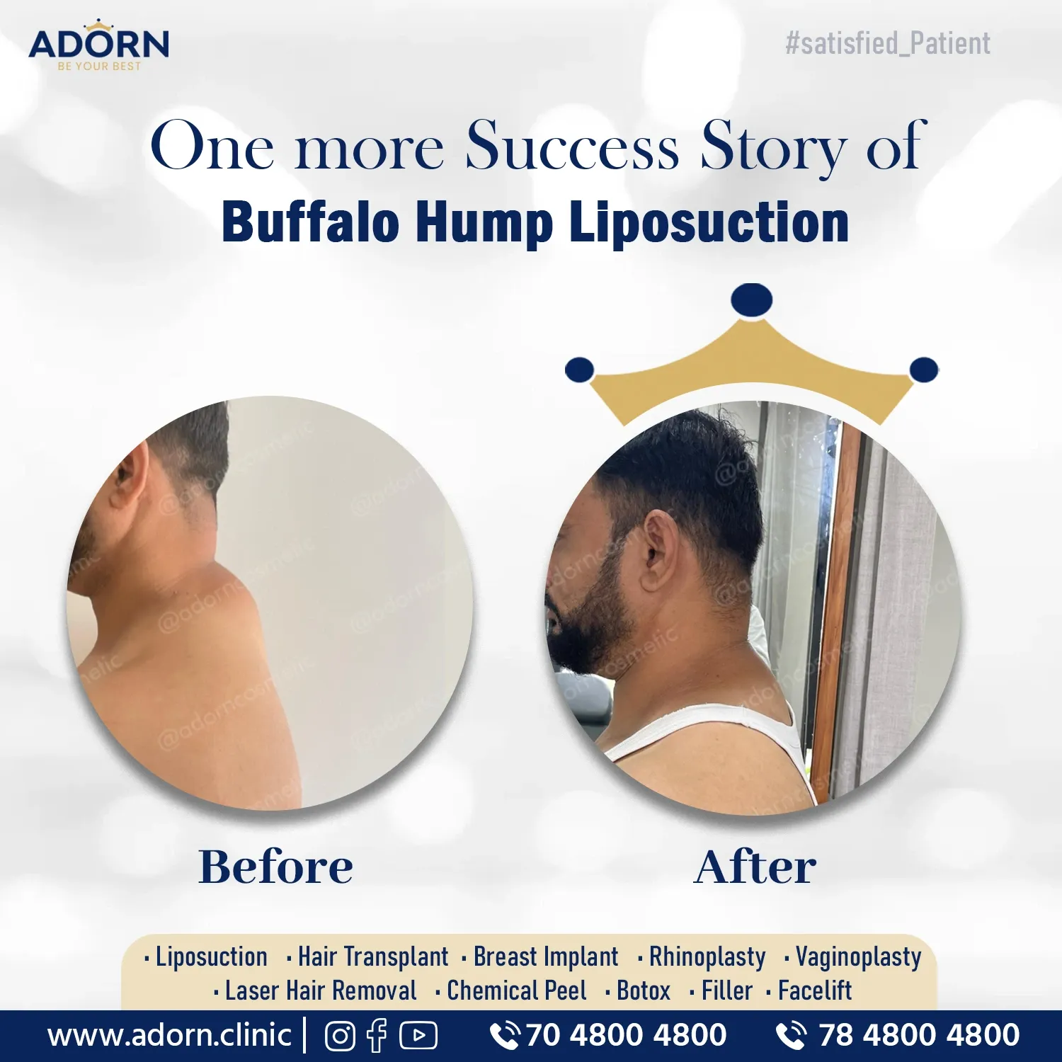 Buffalo Hump Liposuction | Before and After Plastic Surgery Results | Adorn Clinic