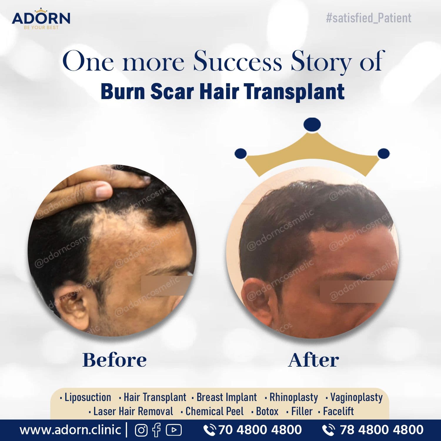 Burn Scar | Before and After Plastic Surgery Results | Adorn Clinic