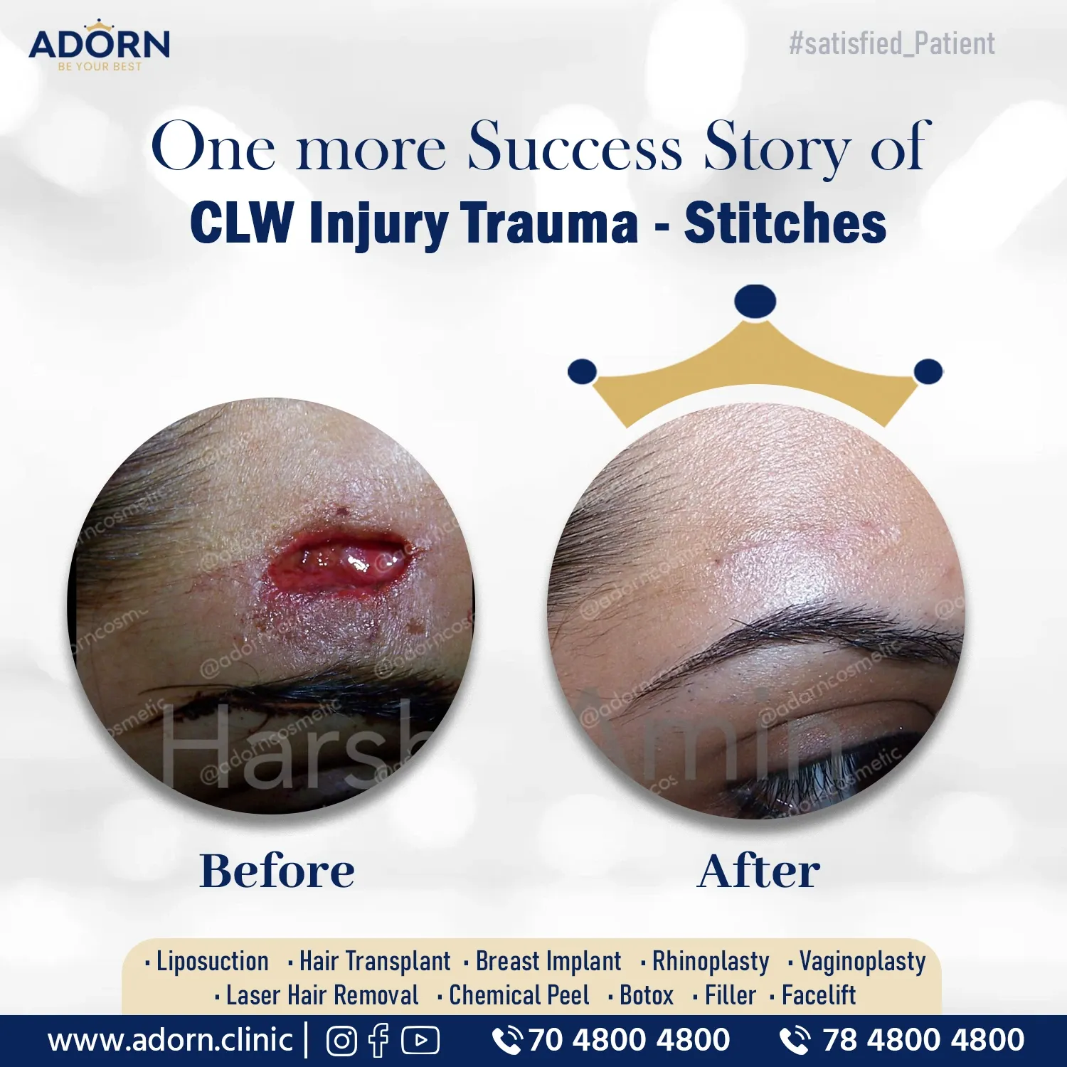 CLW wound | Before and After Plastic Surgery Results | Adorn Clinic
