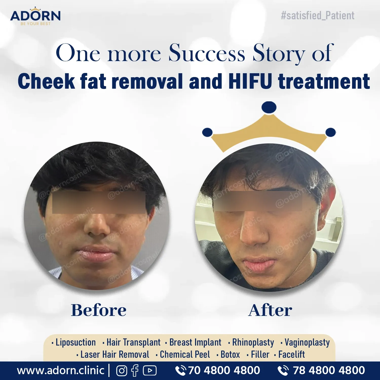 Cheek fat removal and HIFU for jawline | Before and After Plastic Surgery Results | Adorn Clinic