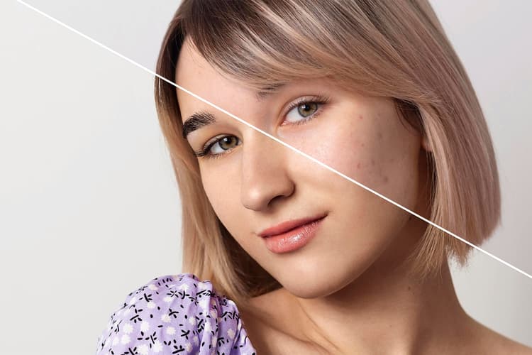 Chemical Peeling: Have beautiful skin even without makeup Chemical Peel Ahmedabad
