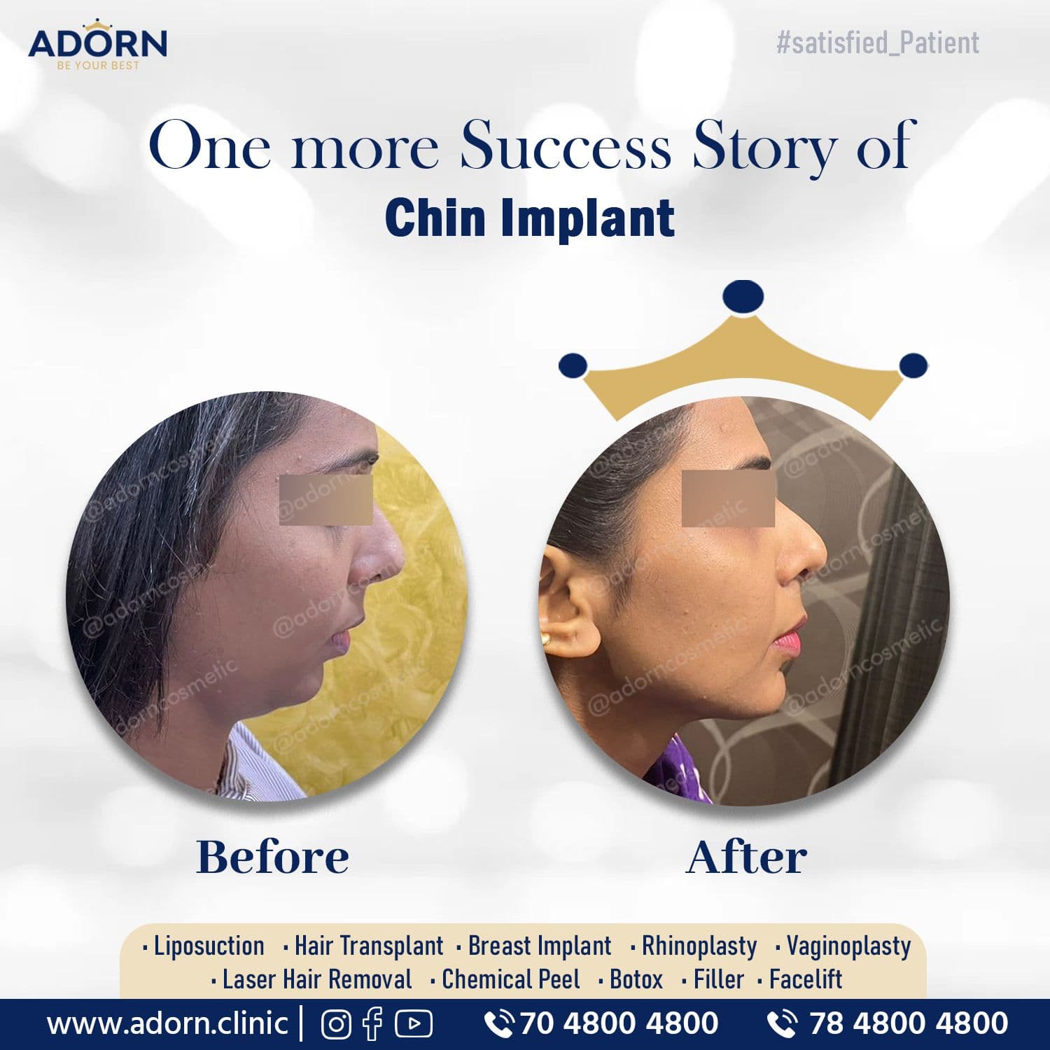 Chin Implant | Before and After Plastic Surgery Results | Adorn Clinic