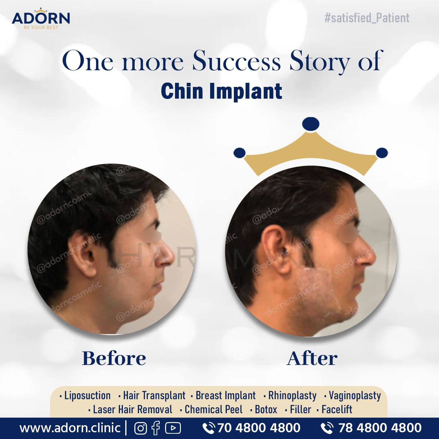 Male Chin implant | Before and After Plastic Surgery Results | Adorn Clinic
