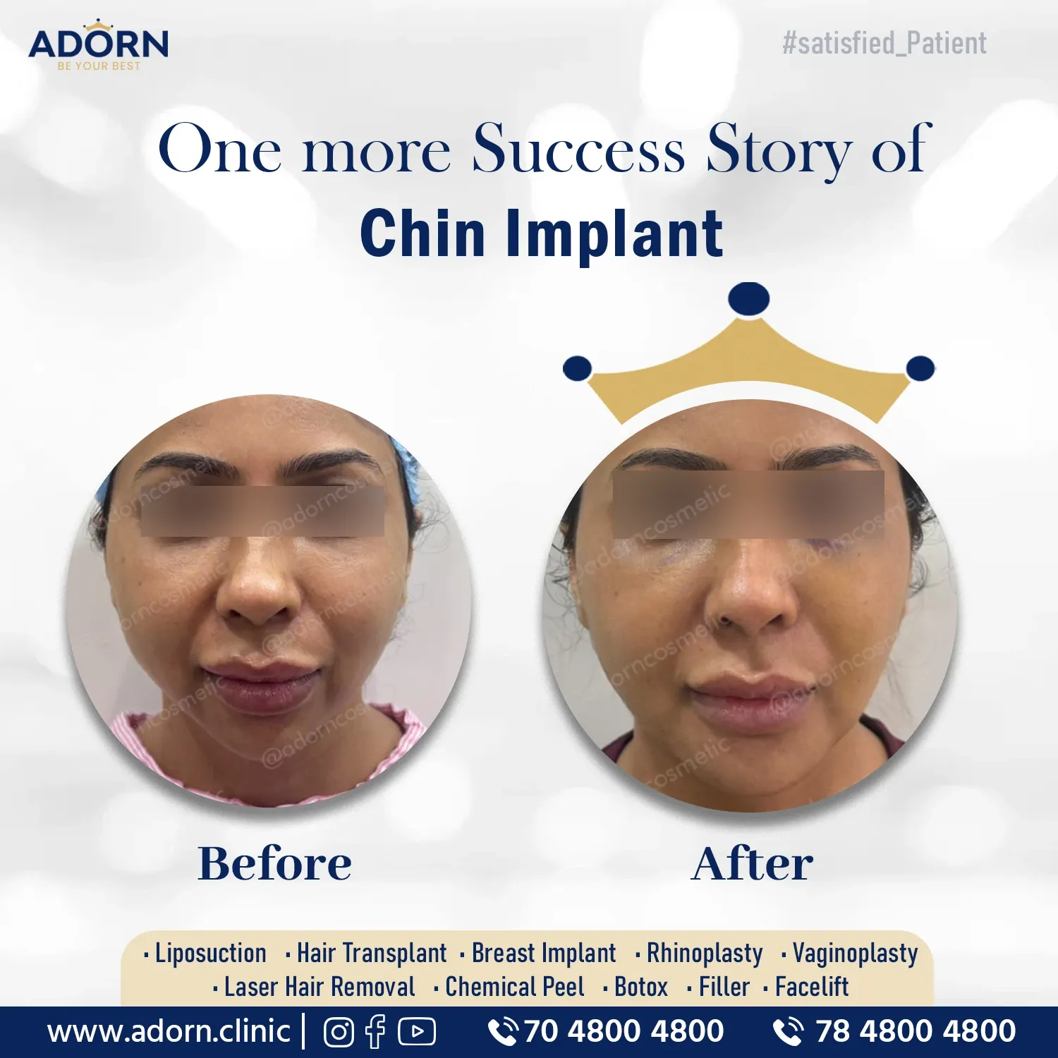 Chin Augmentation | Before and After Plastic Surgery Results | Adorn Clinic