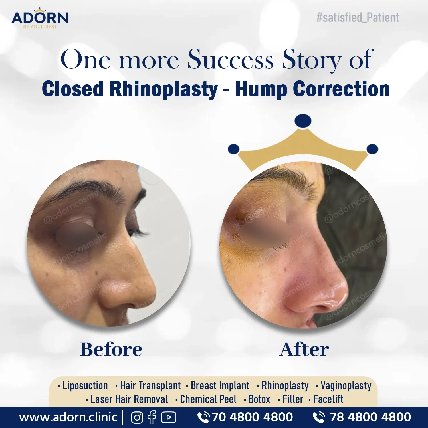 Closed rhinoplasty | Before and After Plastic Surgery Results | Adorn Clinic