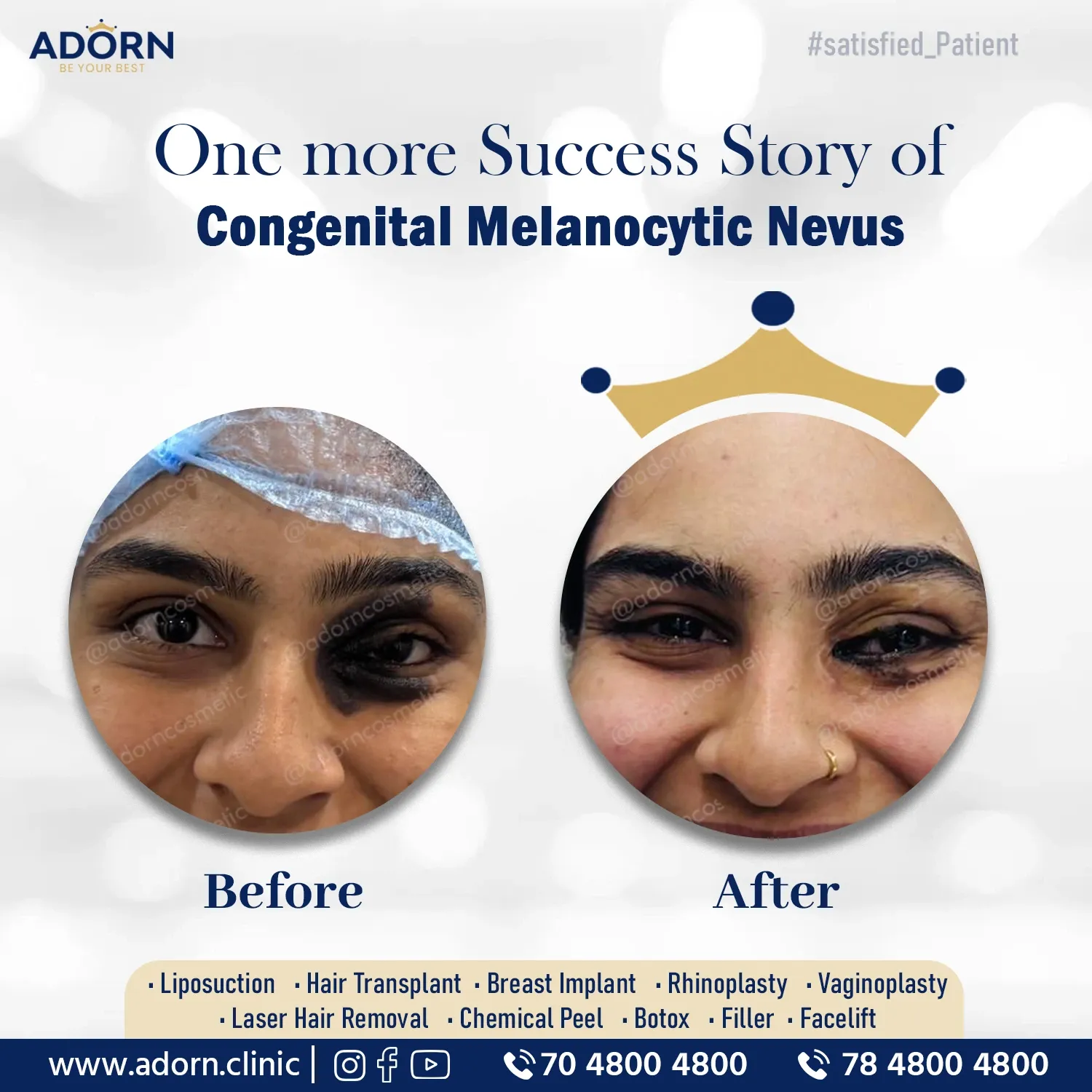 Congenital Melanocytic Nevus | Before and After Plastic Surgery Results | Adorn Clinic
