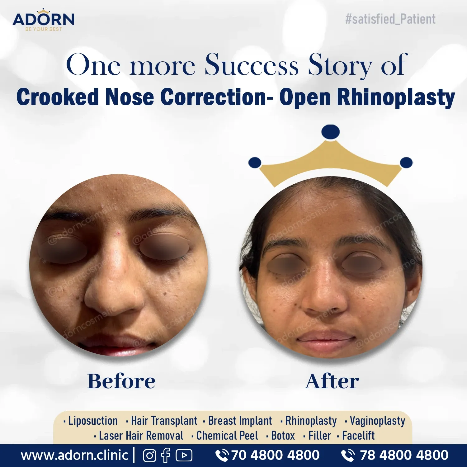 Deviated Nose Surgery | Before and After Plastic Surgery Results | Adorn Clinic