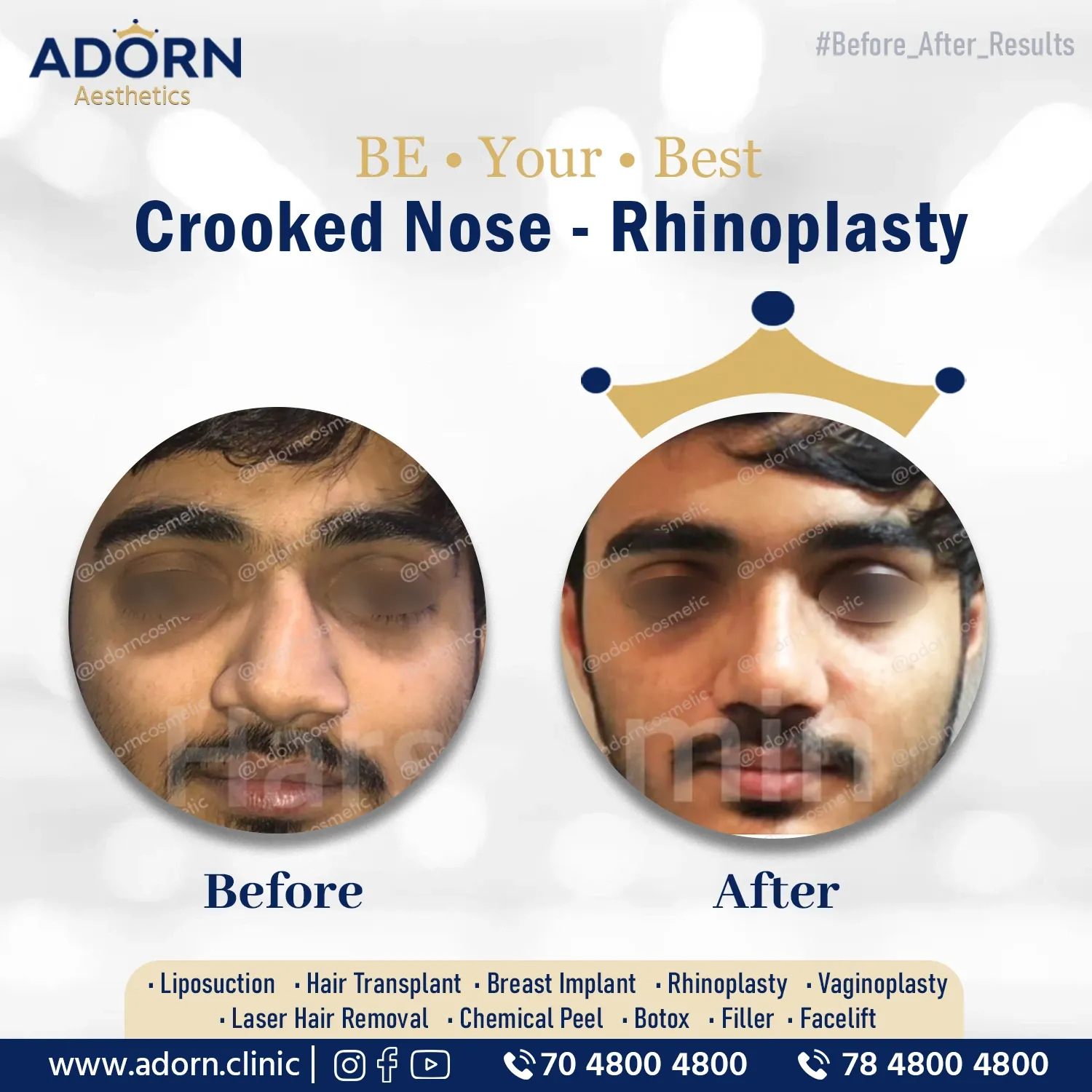 Deviated Nose + Septoplasty | Before and After Plastic Surgery Results | Adorn Clinic