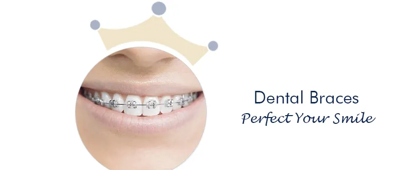 Dental braces Ahmedabad satellite Ambawadi Paldi