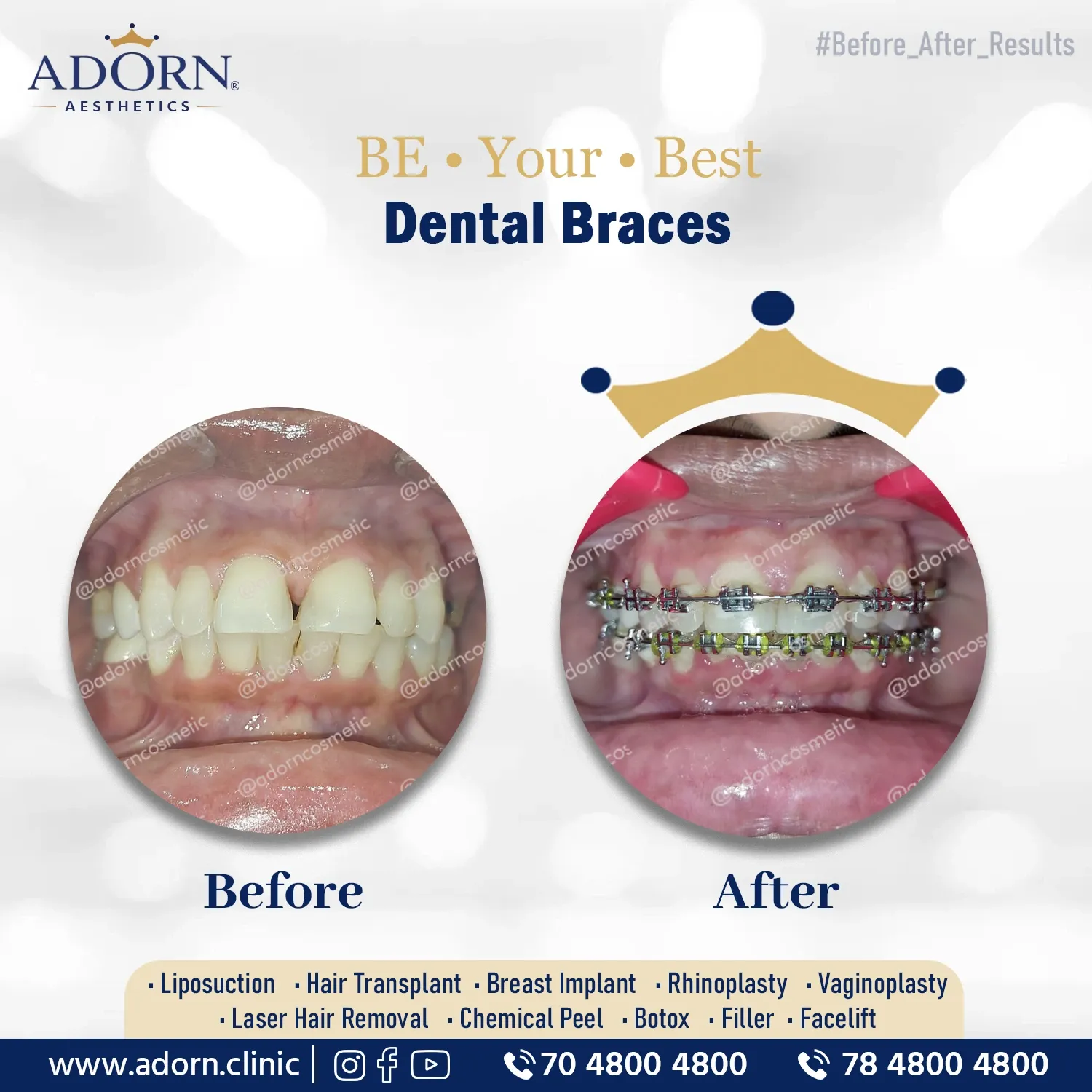 Braces | Before and After Plastic Surgery Results | Adorn Clinic