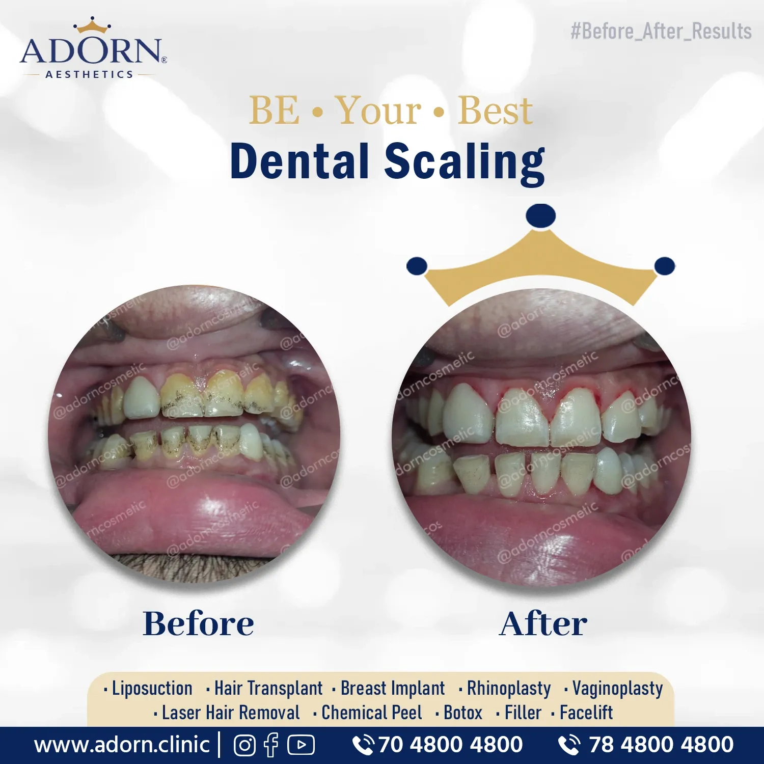 Dental scaling | Before and After Plastic Surgery Results | Adorn Clinic
