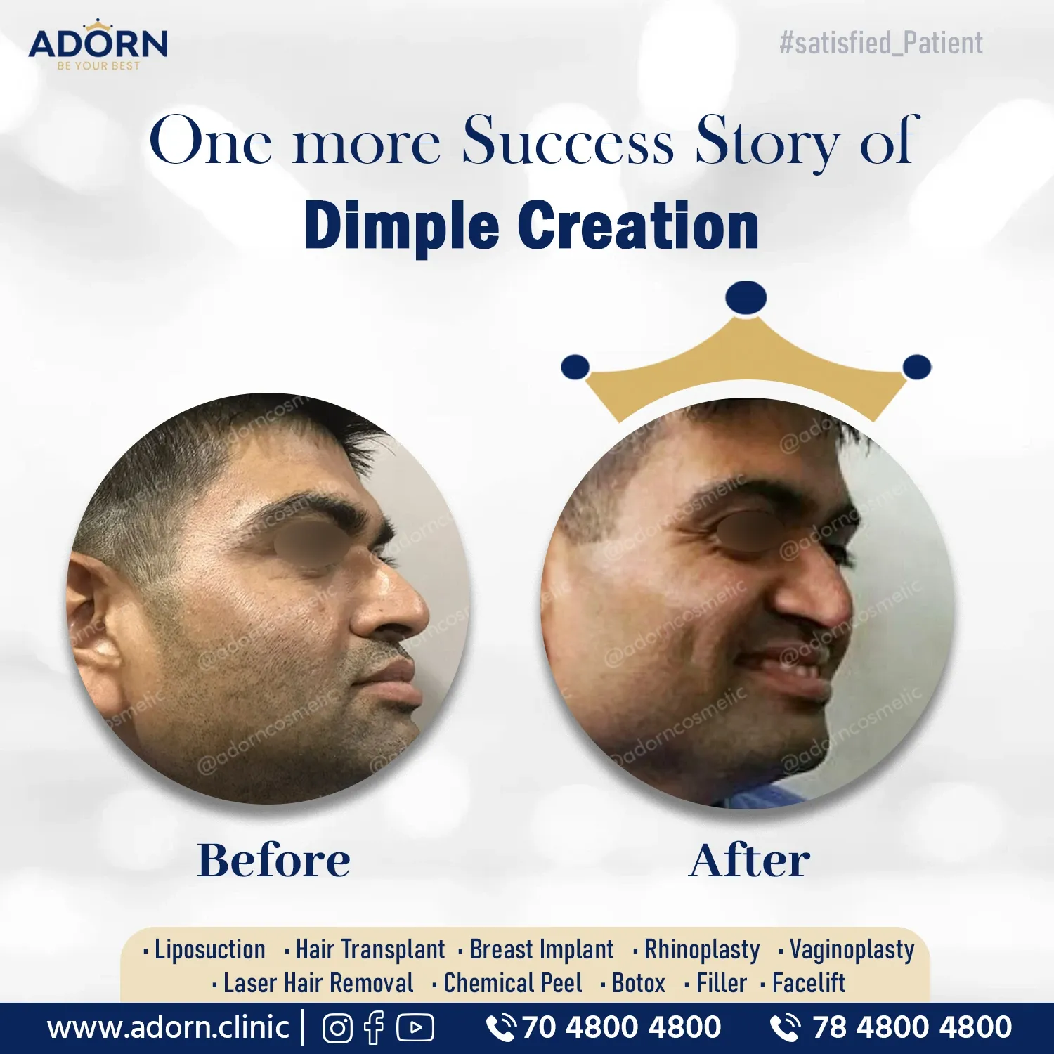 Dimple Surgery | Before and After Plastic Surgery Results | Adorn Clinic