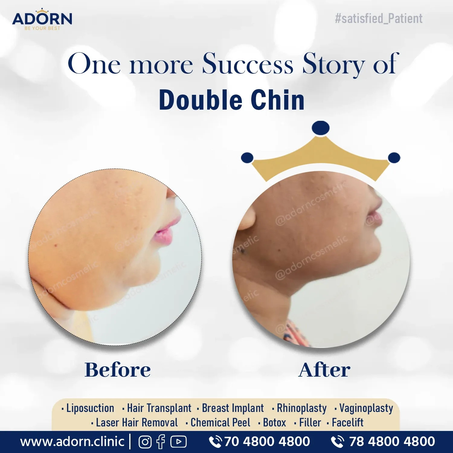 Double Chin Liposuction | Before and After Plastic Surgery Results | Adorn Clinic