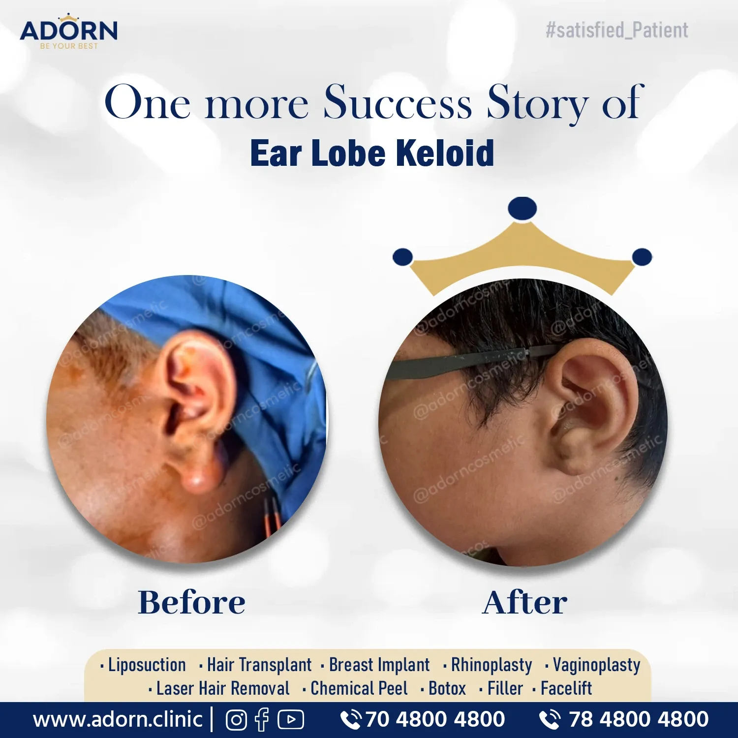 Ear Keloid | Before and After Plastic Surgery Results | Adorn Clinic